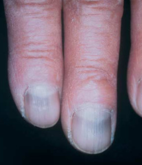 blue fingernails